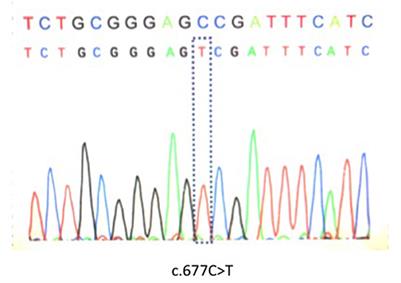 Case report: Young-onset large vessel ischemic stroke due to hyperhomocysteinemia associated with the C677T polymorphism on 5,10-methylenetetrahydrofolate reductase and multi-vitamin deficiency